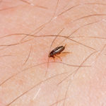 a little flea bites on a human-blog-Florida-Pest-control