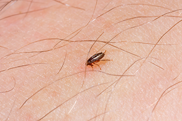 a little flea bites on a human-blog-Florida-Pest-control