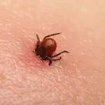 a tick burrowing into a person's skin - keep pests away from your home with florida pest control