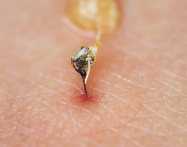 Close up of a bee stinger and venom sac left behind in human skin