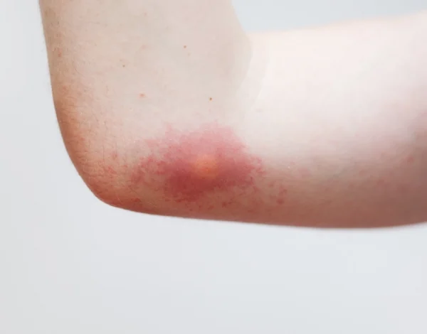 image-stock-1200-wasp-sting-124525324